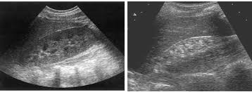 Sonographic Grading Of Renal Cortical Echogenicity And Raised Serum  Creatinine In Patients With Chronic Kidney Disease - Document - Gale  Academic Onefile