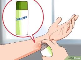 Maybe you would like to learn more about one of these? How To Stop The Burning In First Degree Burns Temporarily 9 Steps