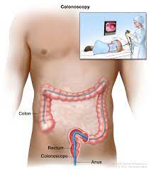 Rectal Cancer Treatment (Pdq®)–Patient Version - Nci