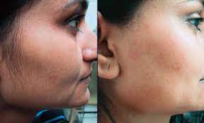 Acquired hypertrichosis lanuginosa is characterized by rapid growth of lanugo hair, particularly on the face. Excess Body Facial Hair Dermanoir