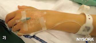 Image result for Difficult Intravenous Access in Children