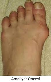 Daha iyi bir uyum daha iyi performans anlamına geldiği için bazı nike ayakkabılarımızı geniş ve ekstra. Halluks Valgus Nedir Nasil Tedavi Edilir Prof Dr Levent Altinel Antalya Ortopedi Doktoru Meniskus On Capraz Bag Diz Protezi Kalca Protezi Ortopedi Ve Travmatoloji Ortopedi Uzmani Ortopedi Cerrahisi Kireclenme Omuz