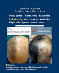 Image result for Anthralin