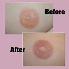Radiation and the type of breast reconstruction performed can have the biggest impact on tattooing, for example, so each tattoo experience must be tailored to patients' individual cases. Vinnie Myers