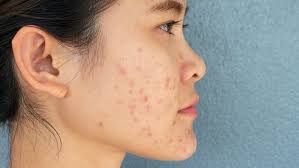 L'atteinte est limitée à la peau. Maladie De Peau Tout Sur Les Problemes Et Affections Cutanees Sante Magazine