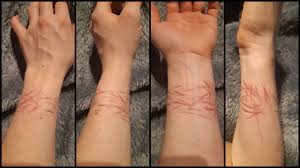 Can you tattoo over scars? Any Artists Out There Wanna Tackle Some Ideas On What To Tattoo Over These Scars I Would Be Most Appreciative 1 Month Clean Selfharmscars