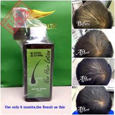 It is made with natural ingredients like the extracts of lemongrass, green tea, white willow bark, and shea butter. Imported Neo Hair Lotion Herbs 100 Natural Stop Hair Loss Root Nutrients Made In Thailand