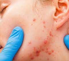 How To Get Rid Of Comedones Acne Neck Acne Acne Treatment Jawline Acne