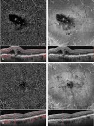 Image result for Acute Vision Loss
