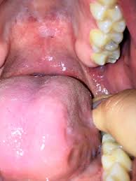 Apr 06, 2016 · it takes about 6 weeks for the jaw bone and gum tissue to repair itself following wisdom teeth extractions. Crater Like Hole Behind Wisdom Tooth Other Mouth Symptoms Oral And Dental Problems Forums Patient