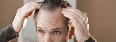 It's no surprise that people are really stressed. Hair Loss Due To Stress How To Prevent Hair Loss A Signi Flickr