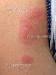 Image result for Cimex lectularius bites