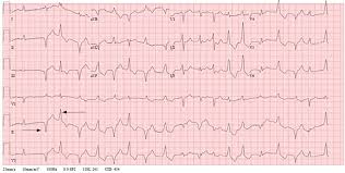 Image result for Digoxin Toxicity