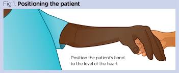 What is delayed capillary refill? How To Measure Capillary Refill Time In Patients Who Are Acutely Ill Nursing Times