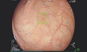 Or to separate groups of numbers. Colon Cancer