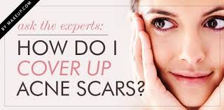 i cover up acne scars