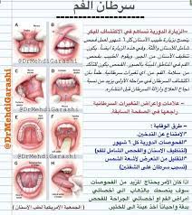 د مهدي قراشي on twitter معلومات مهمة عن سرطان الفم 3 الفحص عن سرطان الفم افتح الصورة المرفقه http t co byua7pyq