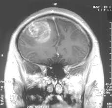 Glioblastoma Wikipedia