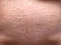 In particular, a serious form of skin cancer called nodular … What Is This White Bump On My Face