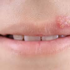 Read about oral herpes symptoms, outbreak stages, signs, treatment, transmission, and prevention. Most People Get Herpes Long Before Their First Hookup