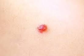 Vaginal boils causes, home remedies, and ways to have you ever experienced ingrown hair bumps around your bikini line? Ingrown Hair Does An Ingrown Hair Cause A Lump