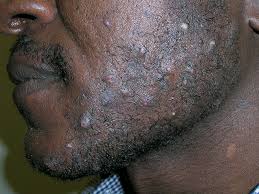 Getting rid of razor bumps is one thing but we should also talk about preventing razor bumps usually result from shaving hair off at angles which leaves them with sharp points. The Best Shave For Personal Grooming And How To Get Rid Of Razor Bumps