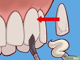 They also prevent tooth decay and subsequent cavities. 3 Ways To Strengthen Tooth Enamel Wikihow