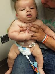 Child hospitalized with high fever