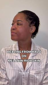 Erin Blackwell of @enlightenu.e shares, “Healing is a journey for melanin  rich skin! This patient of mine isn’t 100% healed by the end of the video,  but it’s an excellent peek into what you can expect ...