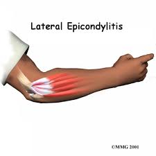 Symptoms include thickening and redness over the biceps tendon. Elbow Pain 321gomd