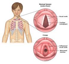 Image result for Croup