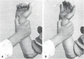 Le signe de tromner est similaire au signe de hoffman, mais le doigt est dévié vers le haut. Scielo Brasil Babinski S Hand Sign Many Have Tried Babinski S Hand Sign Many Have Tried