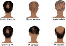 Treatment of severe alopecia areata with intralesional steroid injections. Immunopathogenesis Of Alopecia Areata Sciencedirect