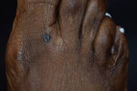 A series of mutations in the dna of the cell creates cancer. Skin Cancer Photo Gallery