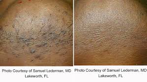 Best for removing coarse hair from body + pubic region. Coolglide Laser Hair Removal Lakes Dermatology