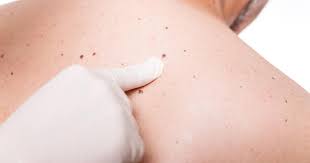 This skin cancer can also cause symptoms, such as: What Are The Symptoms Of Skin Cancer