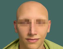 Alopecia universalis is an advanced form of alopecia areata. Androgenic Alopecia