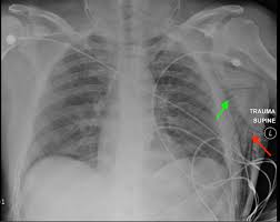 Image result for Emphysema