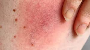 Image result for spinne biss haut reaktion