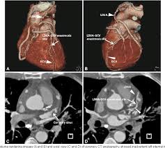 Check spelling or type a new query. Pdf Iatrogenic Left Internal Mammary Artery To Great Cardiac Vein Anastomosis Treated With Coil Embolization Semantic Scholar