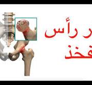 ‫Osteonecrosis / تنخر رأس الفخذ و هل يؤدي الى خشونة الورك؟‬‎