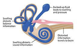 Image result for Inner Ear Decompression Sickness