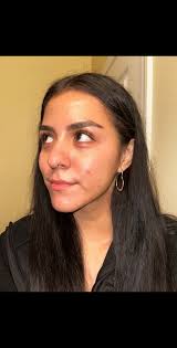 Before and After Radio Frequency Face