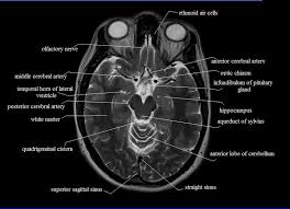 Normal Mri Top Brain Google Search Mri Brain Brain Anatomy Radiology