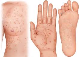 Image result for syphilis symptoms