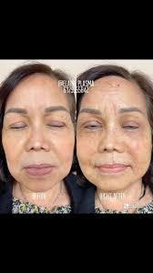 After just 1 hour of undergoing Ultra Cold plasma treatment, noticeable  changes are evident. Thanks to its fat-reducing and skin-tightening  properties, the face has slimmed down, with a smaller ...