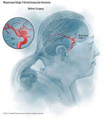 What Is Moyamoya Disease Swedish Medical Center Seattle And Issaquah