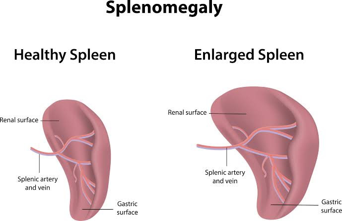 Vergleich: Normalgröße vs. Splenomegalie, AI generated