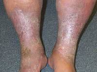 Image result for Lipodermatosclerosis