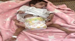 .صباح اليوم إجراء عملية فصل التوأم الطفيلي اليمني عائشة أحمد سعيد محيمود، بقيادة وبعملية اليوم يصل عدد عمليات فصل التوائم إلى الخمسين ضمن خبرة رائدة للمملكة على. S8iweyuw1d57vm
